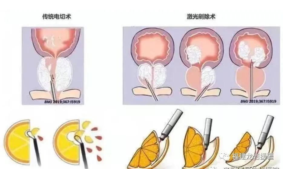 前列腺b超图图片